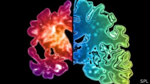 Comparación entre cerebro enfermo y sano
