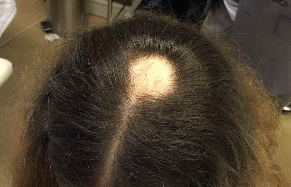La caída abundante de cabello oculta otros padecimientos