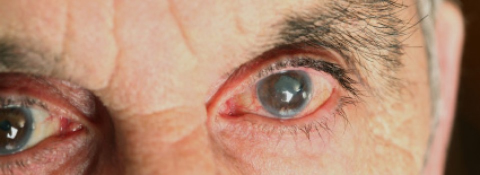 La ingrata experiencia de perder un ojo por glaucoma