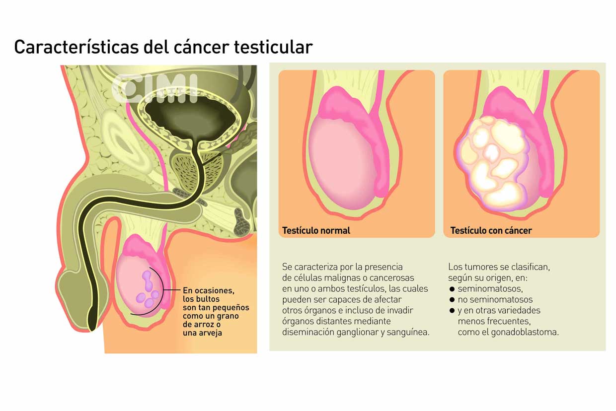 En el 60 por ciento de los casos de cáncer de testículo,  la detección es tardía