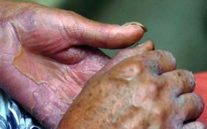 Aún existen casos de enfermos de lepra en México