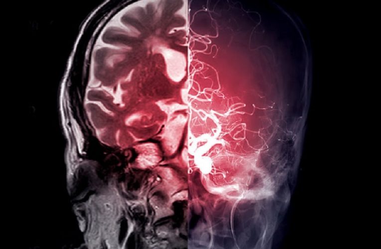 Un estudio de Cleveland Clinic muestra que la estimulación cerebral profunda es alentadora para los pacientes con accidente cerebrovascular