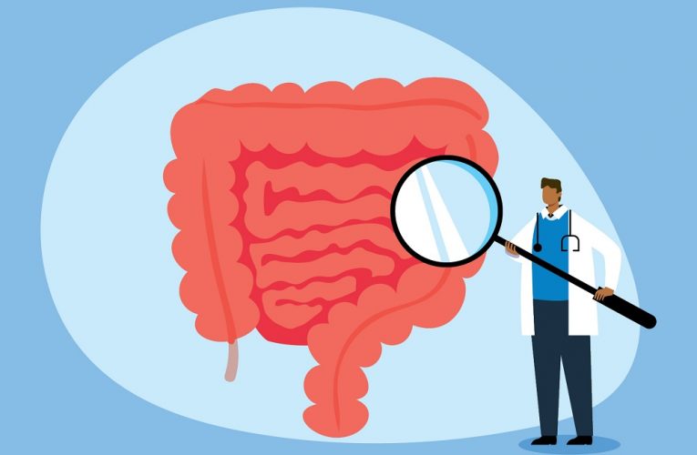 ¿Cómo puedo reducir el riesgo de cáncer de colon?